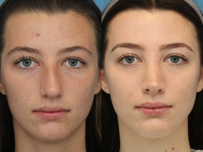 Case 3996 - Woman treated with Rhinoplasty