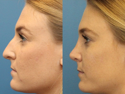 Case 3997 - Woman treated with Rhinoplasty