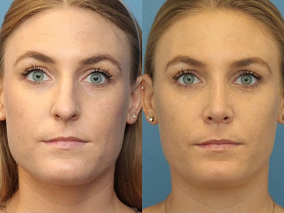 Case 3998 - Woman treated with Rhinoplasty