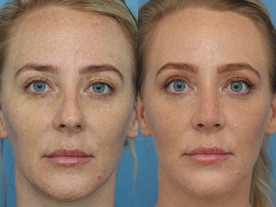 Case 3999 - Woman treated with Rhinoplasty