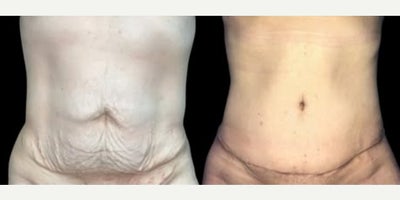 Case: 4 - before and after photo of Woman treated with Tummy Tuck by Stephen T. Greenberg, MD, FACS