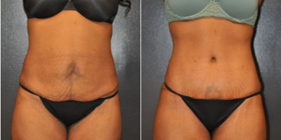 Case 40 - Woman treated with Tummy Tuck