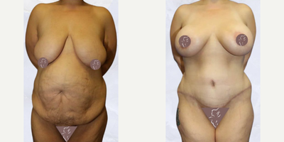 Case 400 - 35-44 year old woman treated with Mommy Makeover, Tummy Tuck, Breast Augmentation