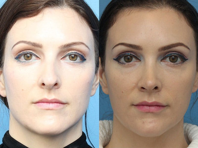 Case 4000 - Woman treated with Rhinoplasty