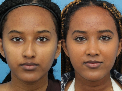 Case 4001 - Woman treated with Rhinoplasty