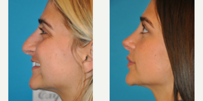 Case 4002 - Woman treated with Rhinoplasty