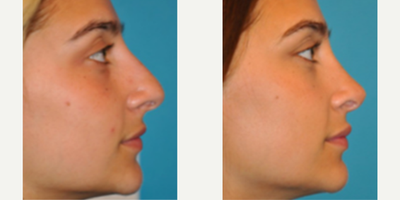 Case 4003 - Woman treated with Rhinoplasty