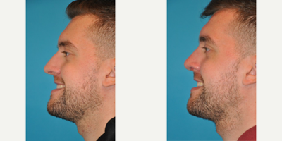 Case 4004 - Man treated with Rhinoplasty