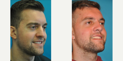 Case 4005 - Man treated with Rhinoplasty