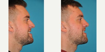 Case 4006 - Man treated with Rhinoplasty