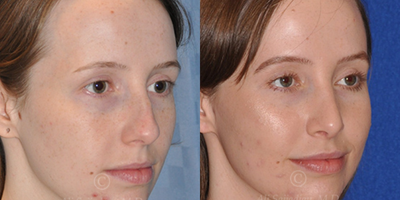 Case 4007 - Woman treated with Rhinoplasty