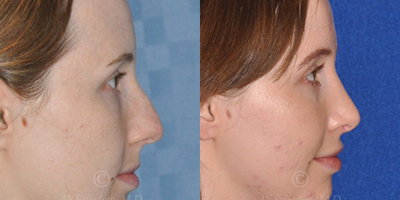 Case 4008 - Woman treated with Rhinoplasty