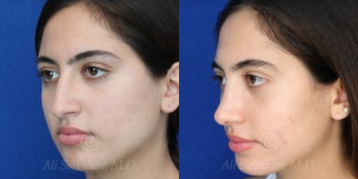 Case 4009 - Woman treated with Rhinoplasty