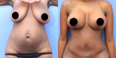 Case 401 - Woman treated with Tummy Tuck, Breast Lift