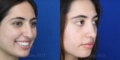 Case 4010 - Woman treated with Rhinoplasty