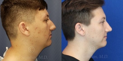 Case 4011 - Man treated with Rhinoplasty