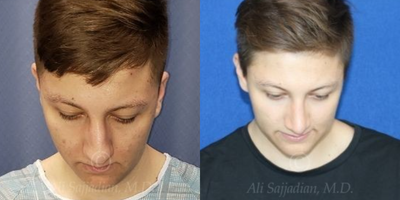 Case 4012 - Man treated with Rhinoplasty