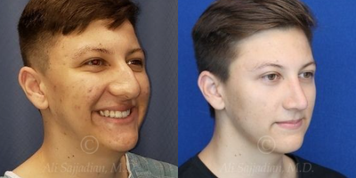 Case 4013 - Man treated with Rhinoplasty