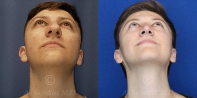 Case 4014 - Man treated with Rhinoplasty