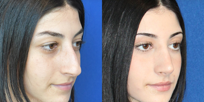 Case 4015 - Woman treated with Rhinoplasty