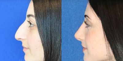 Case 4016 - Woman treated with Rhinoplasty