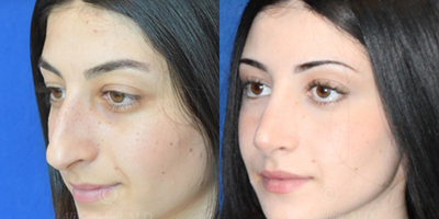Case 4017 - Woman treated with Rhinoplasty