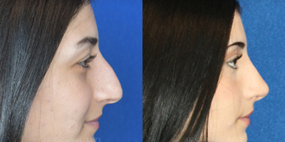 Case 4018 - Woman treated with Rhinoplasty
