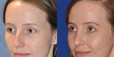 Case 4019 - Woman treated with Rhinoplasty