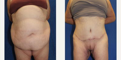 Case 402 - 25-34 year old woman treated with Tummy Tuck