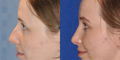 Case 4020 - Woman treated with Rhinoplasty