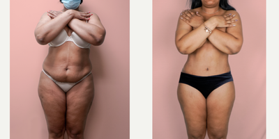 Case 403 - 25-34 year old woman treated with Tummy Tuck