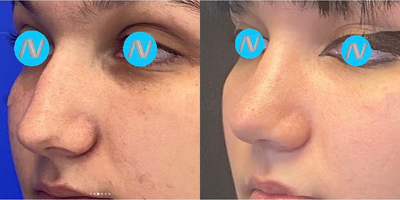 Case 4033 - Woman treated with Rhinoplasty