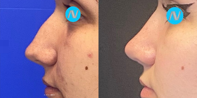 Case 4034 - Woman treated with Rhinoplasty