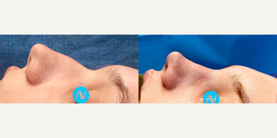 Case 4035 - Woman treated with Rhinoplasty