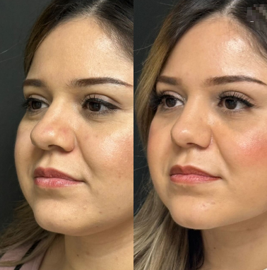 Case 4036 - Woman treated with Rhinoplasty