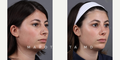 Case 4037 - Woman treated with Rhinoplasty