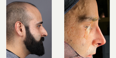 Case 4039 - Man treated with Rhinoplasty