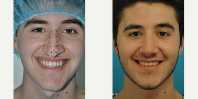 Case 4040 - Rhinoplasty