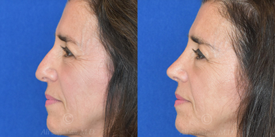 Case 4041 - Woman treated with Rhinoplasty