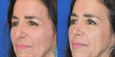 Case 4042 - Woman treated with Rhinoplasty