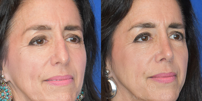 Case 4043 - Woman treated with Rhinoplasty