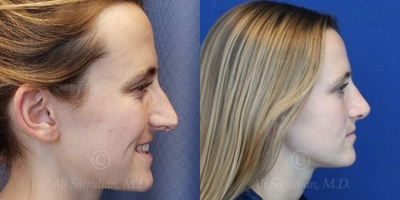 Case 4044 - Woman treated with Rhinoplasty