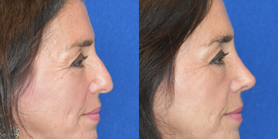 Case 4045 - Woman treated with Rhinoplasty