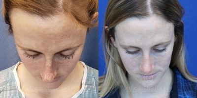 Case 4046 - Woman treated with Rhinoplasty