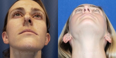 Case 4047 - Woman treated with Rhinoplasty