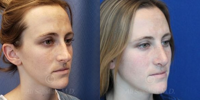 Case 4048 - Woman treated with Rhinoplasty