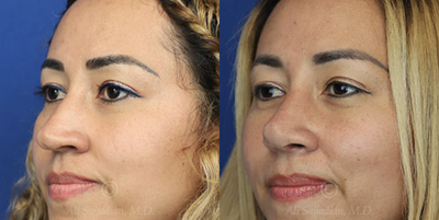 Case 4049 - Woman treated with Rhinoplasty