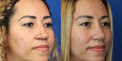 Case 4050 - Woman treated with Rhinoplasty