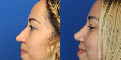 Case 4051 - Woman treated with Rhinoplasty