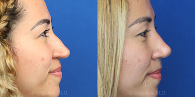 Case 4052 - Woman treated with Rhinoplasty
